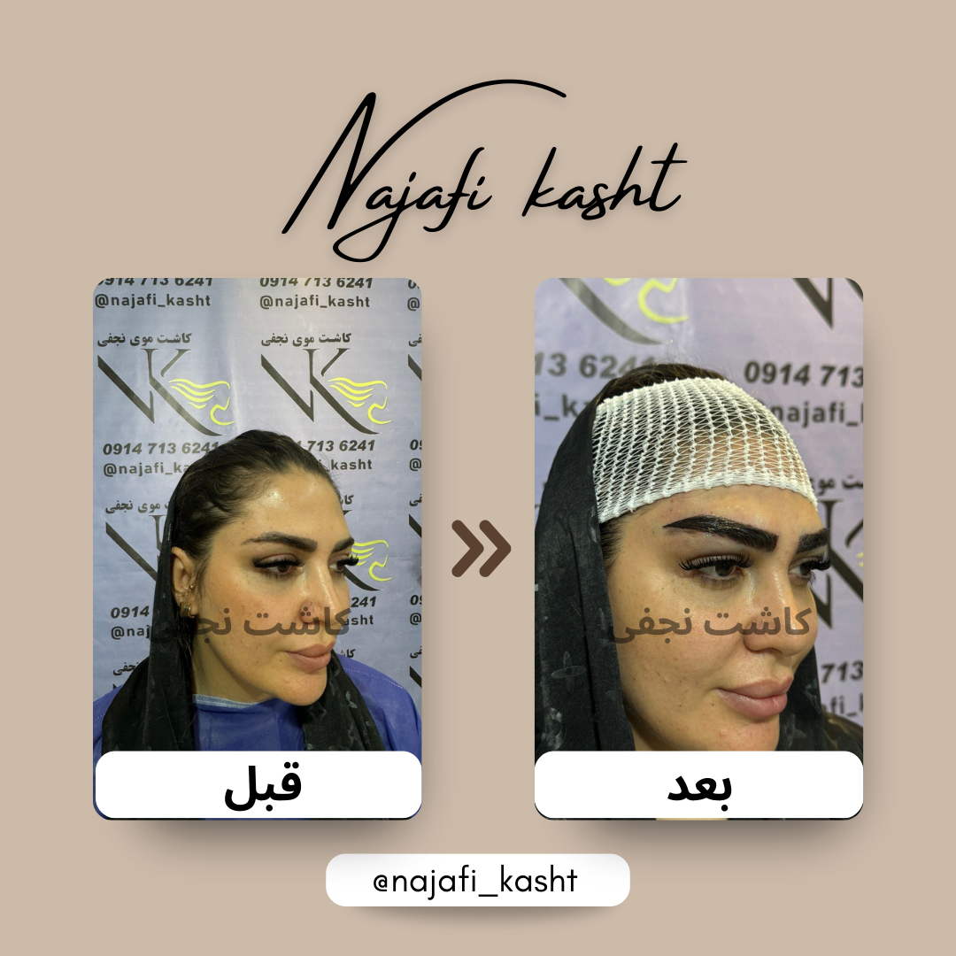 نتیجه فوق‌العاده کاشت ابرو – قبل و بعد | توسط علی نجفی