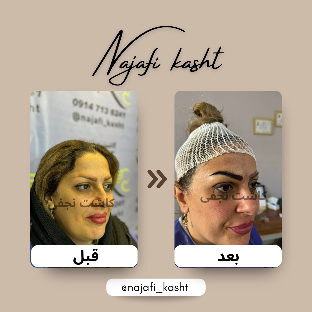 کاشت ابرو طبیعی بانوان – قبل و بعد | کاشت ابرو علی نجفی