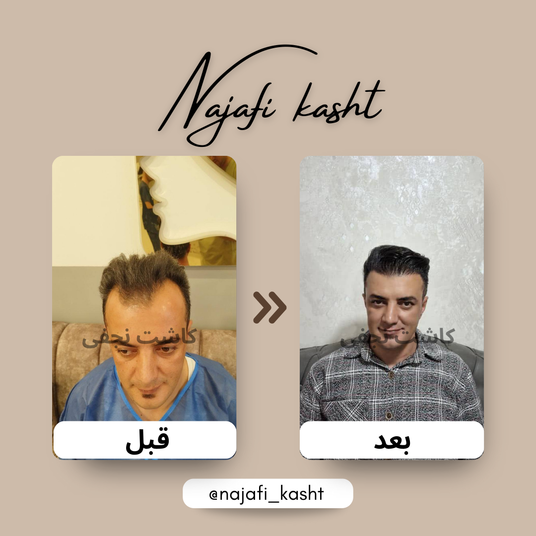 کاشت موی طبیعی آقایان – تصویر قبل و بعد | علی نجفی