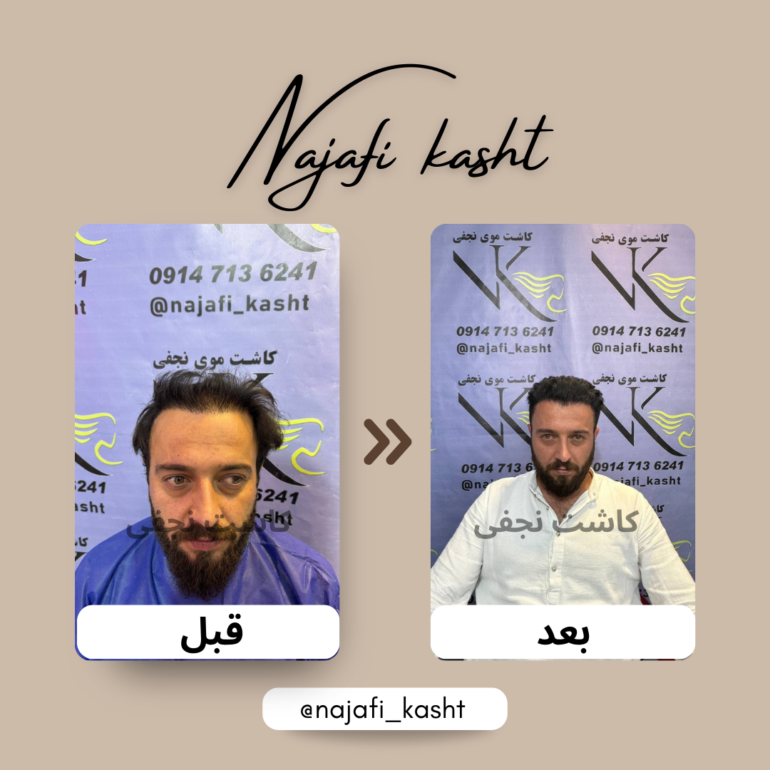 کاشت مو برای افزایش تراکم و پرکردن نواحی خالی | توسط علی نجفی