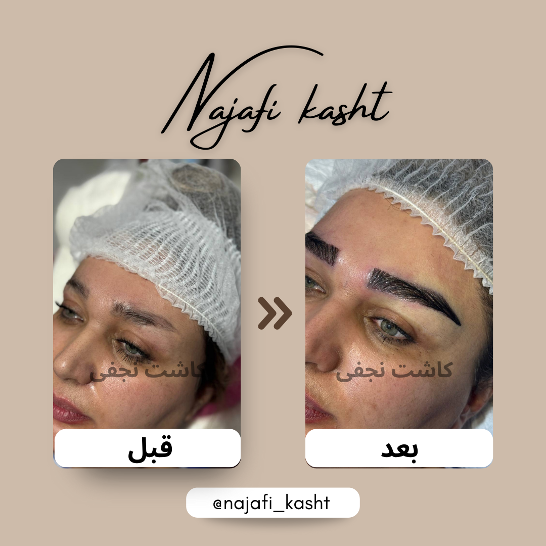کاشت ابرو برای ابروهای کم‌پشت – قبل و بعد | توسط علی نجفی