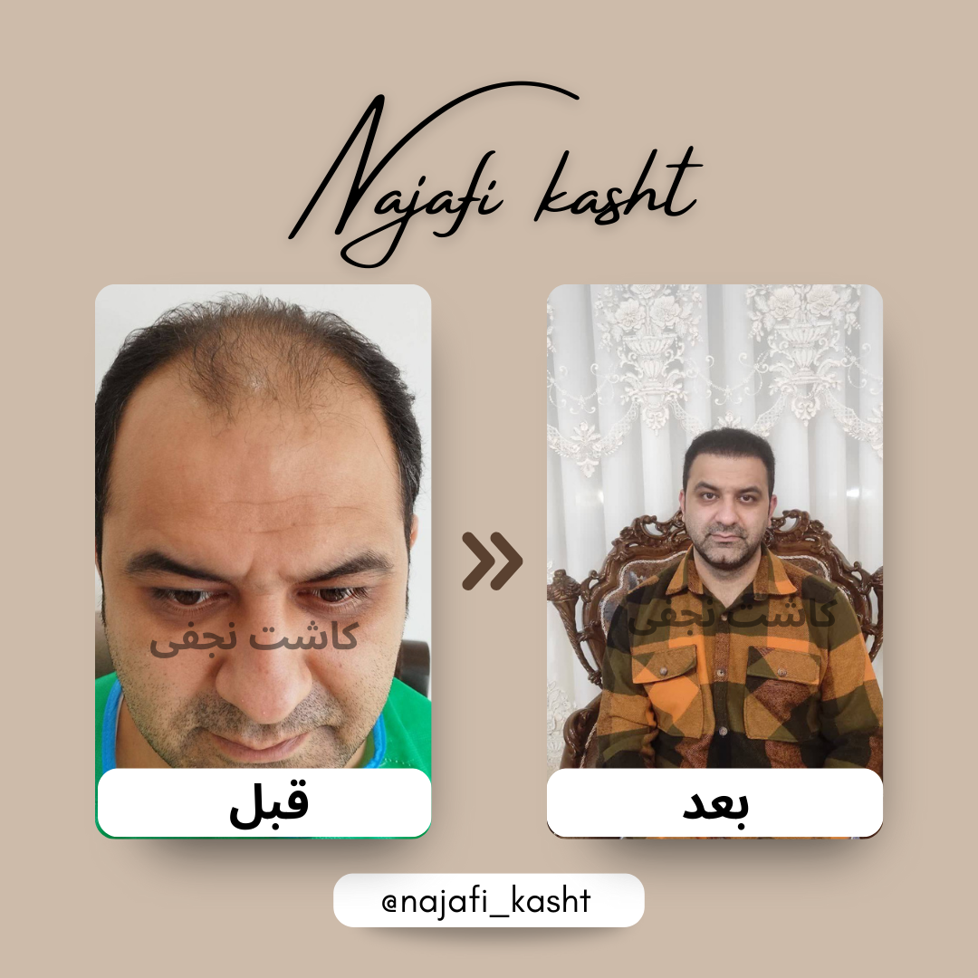 کاشت مو برای طاسی – تغییر چشمگیر آقایان | کاشت مو علی نجفی