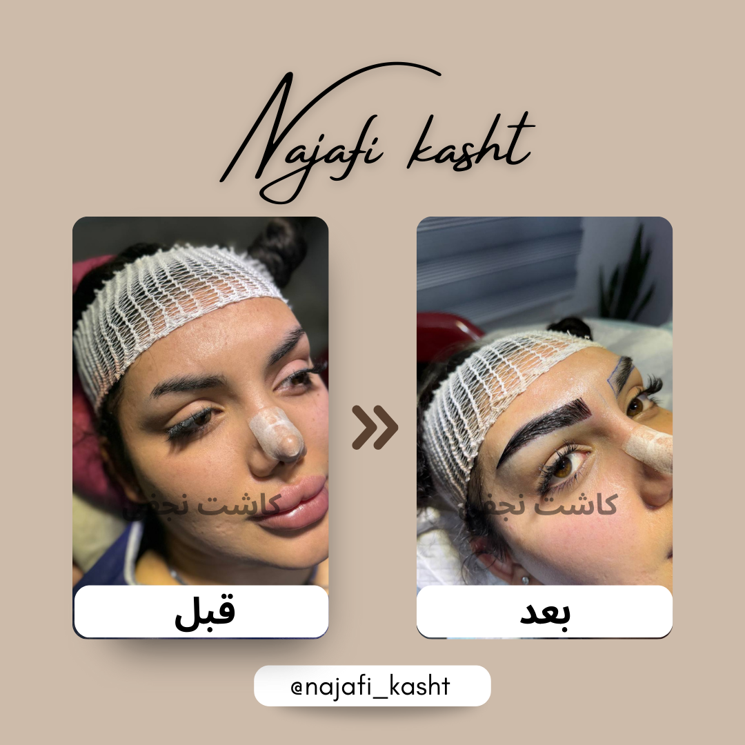 کاشت ابرو با فرم خاص و حالت‌دهی متفاوت – قبل و بعد | توسط علی نجفی