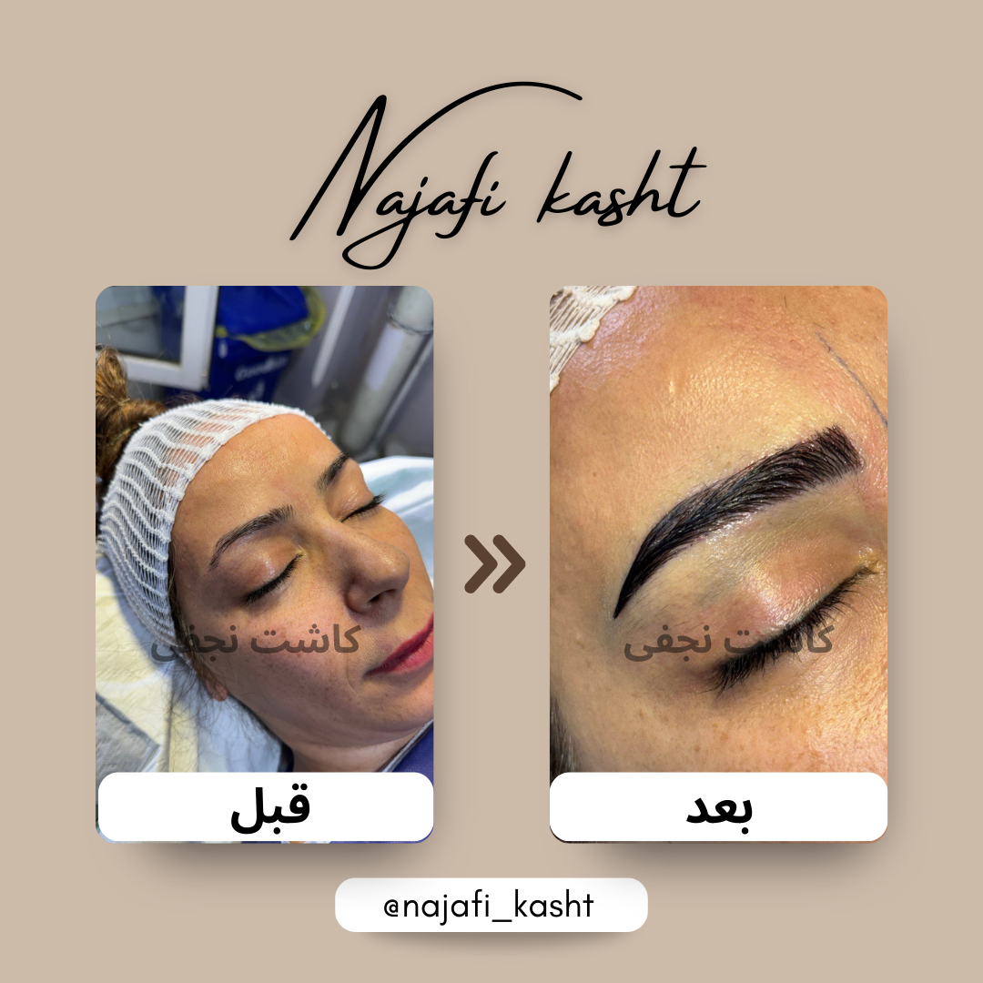 کاشت ابرو بسیار طبیعی – قبل و بعد | طراحی توسط علی نجفی