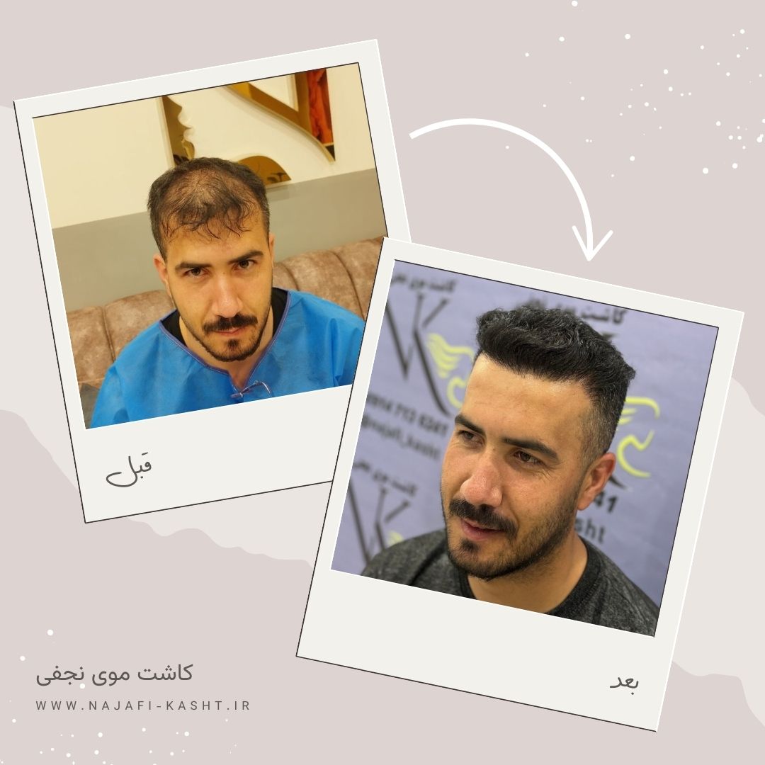 نتیجه کاشت مو مردانه با تراکم بالا – قبل و بعد