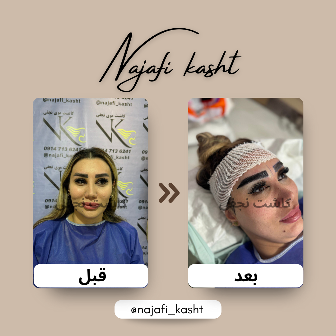 کاشت ابرو طبیعی برای خانم – تصاویر قبل و بعد | علی نجفی