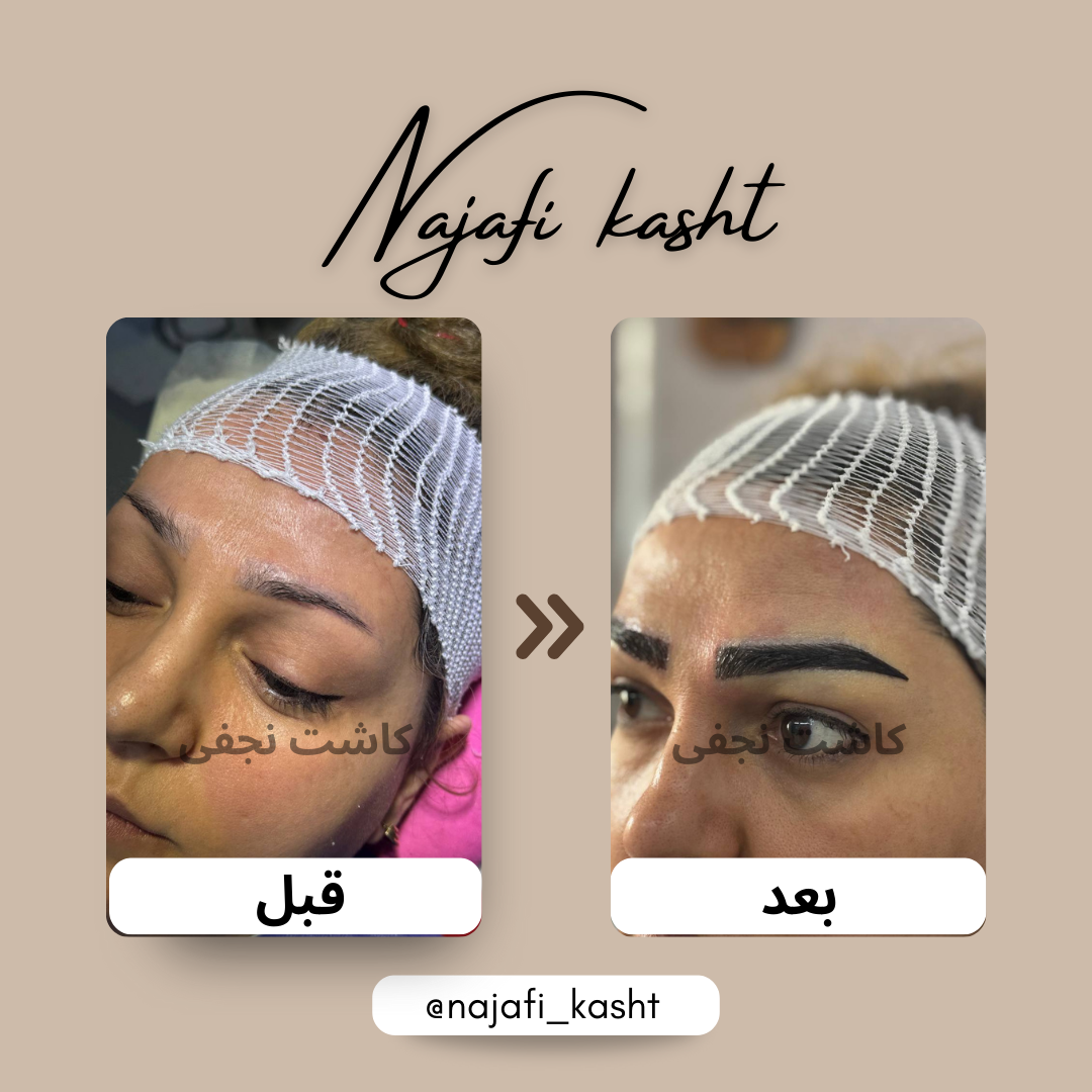 کاشت ابرو با ظاهر کاملاً طبیعی – قبل و بعد | طراحی علی نجفی