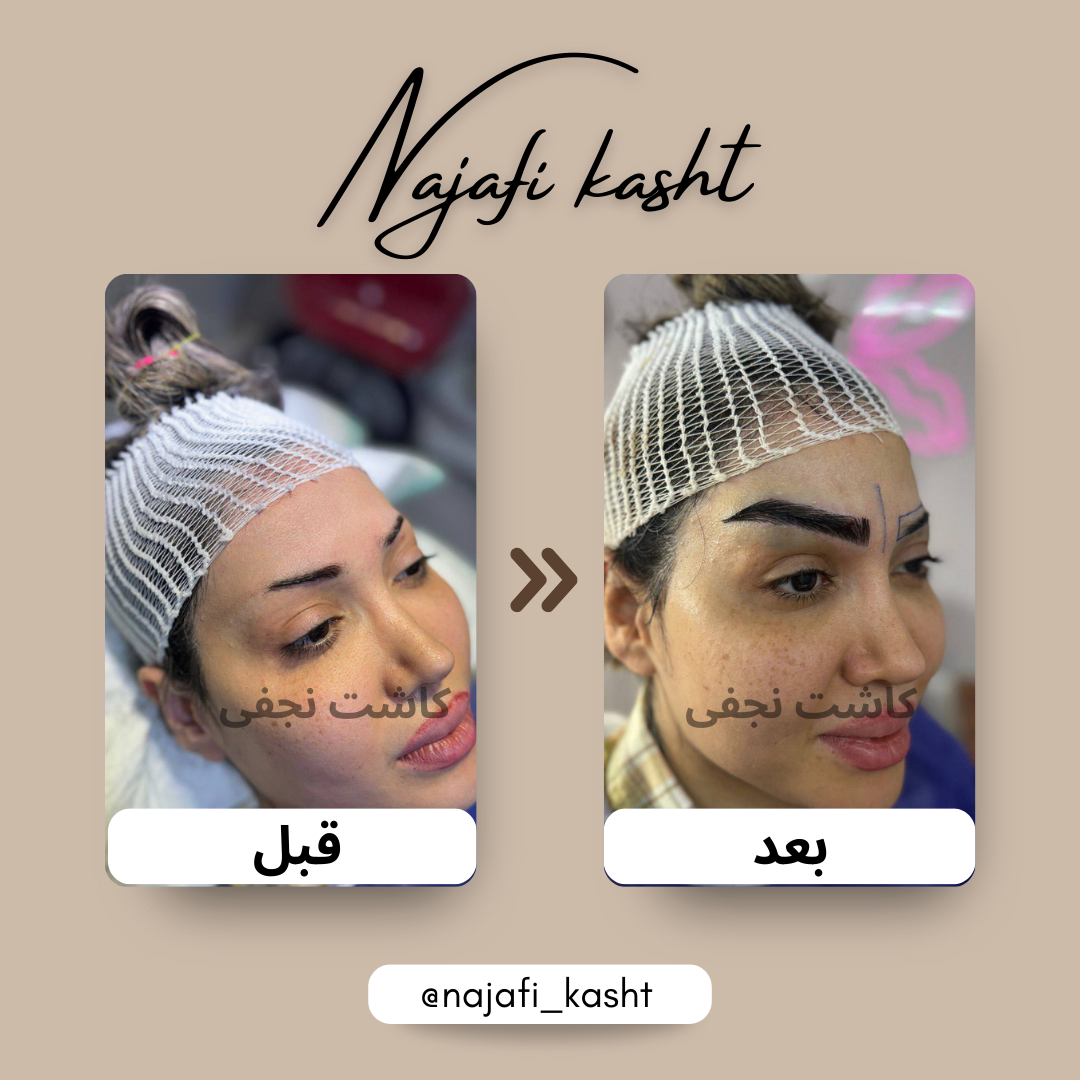 کاشت ابروخانم نمونه قبل بعد نجفی