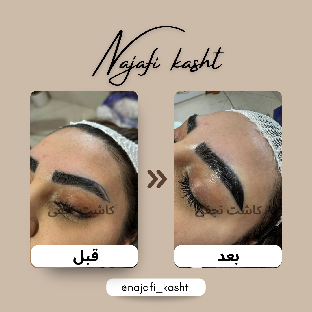 کاشت ابرو پرپشت و متقارن – قبل و بعد | اجرا توسط علی نجفی
