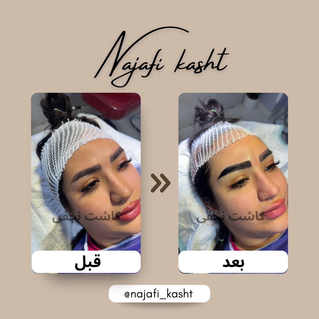 کاشت ابرو طبیعی و هماهنگ با چهره – قبل و بعد | توسط علی نجفی