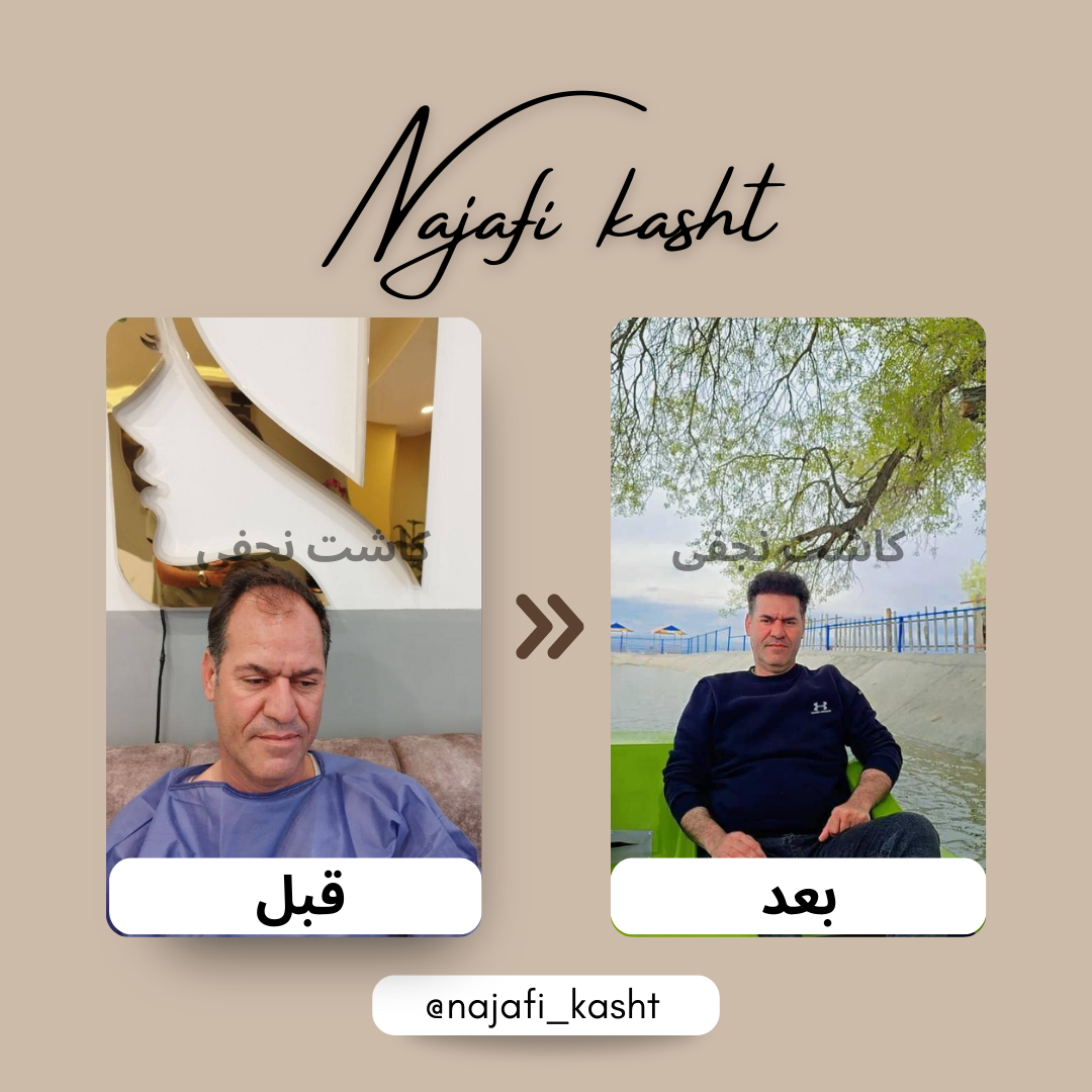 کاشت موی طبیعی آقایان – بازگشت تراکم مو | توسط علی نجفی